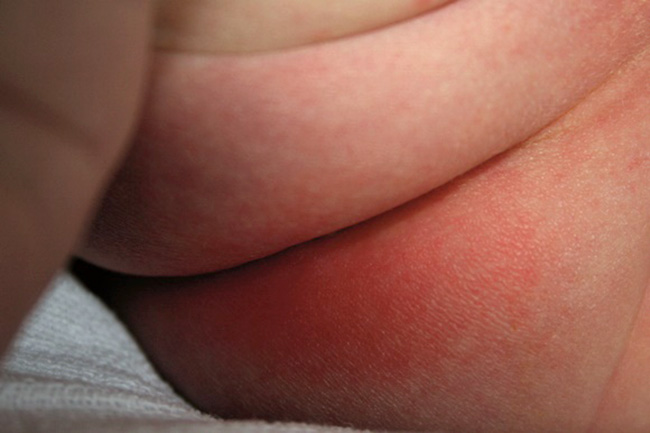 hăm tã thường bị ở trẻ sơ sinh